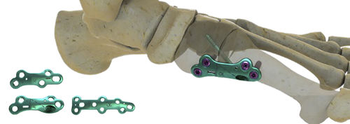 Placca per artrodesi per articolazione metatarso-falangea - MEDIALMAX™ - Wright Medical Technology - mediale / in metallo