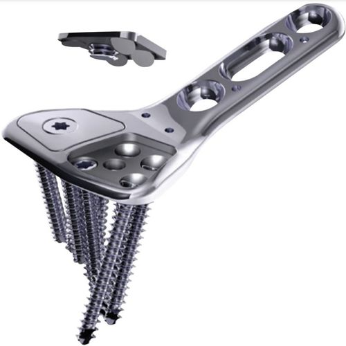 Placca di compressione per radio - COVERLOC™ - Wright Medical Technology - distale / bloccata / in metallo
