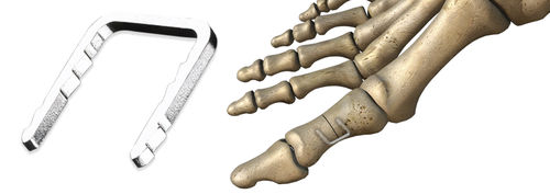 Graffa ortopedica per avampiede - CHARLOTTE™ - Wright Medical Technology - non assorbibile