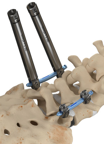 Sistema di posizionamento di viti peduncolari mininvasivo - Invictus™ - Alphatec Spine