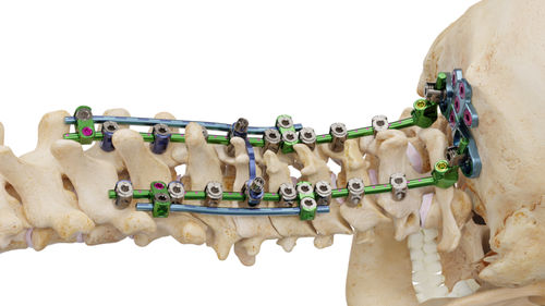 Sistema di osteosintesi occipito-cervico-toracico - Invictus® OCT - Alphatec Spine - via posteriore / per adulti