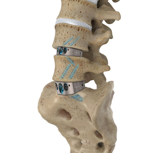 Gabbia intersomatica lombo-sacrale - IdentiTi™ ALIF Standalone - Alphatec Spine - via anteriore / in titanio