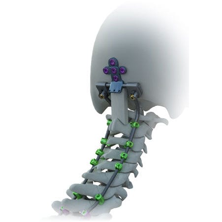 Sistema di osteosintesi occipitocervicale - Avalon® - Alphatec Spine - via posteriore / per adulti