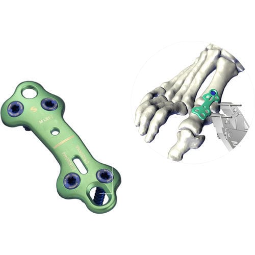 Placca per artrodesi per avampiede - UltOS™ - Ortho Solutions - per falange del piede / bloccata / non bloccata