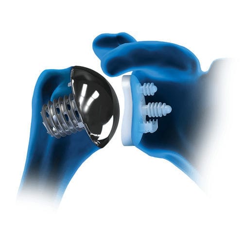 Protesi della spalla cementata o non cementata - Eclipse™ - Arthrex