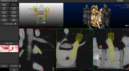 Software per chirurgia robotica - NAVIX - Claron Technology - di navigazione chirurgica / di rachide