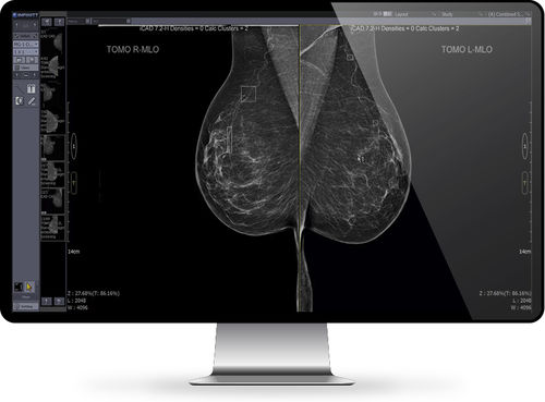 PACS per diagnostica per immagini - Mammo - INFINITT North America