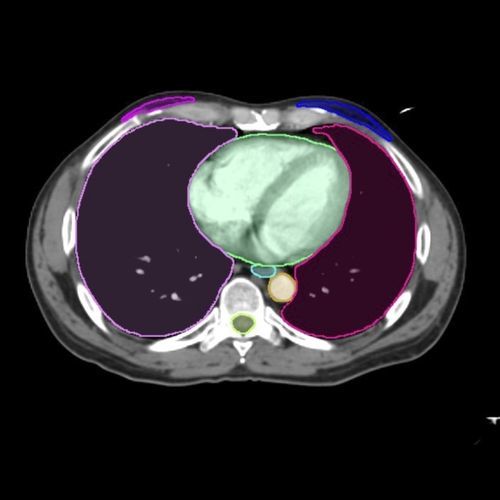 Piattaforma AI per diagnostica per immagini - Contour ProtégéAI® - MIM Software - di riconoscimento dei contorni / di standardizzazione