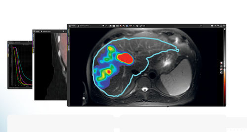 Software per tomografia computerizzata - MIM SurePlan™ LiverY90 - MIM Software - TEP / SPECT / di oncologia
