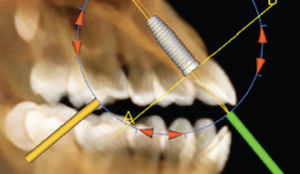 Modulo software per implantologia dentale - Anatomage - di visualizzazione 3D / di pianificazione / di simulazione d'impianto dentale