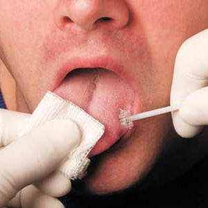 Spazzola citologica orale - OralCDx® - CDx Diagnostics - monouso