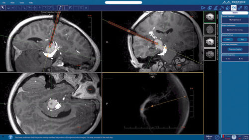Software di pianificazione - NeuroBlate ® SoftwareTM NeuroBlate ® - Monteris Medical - di acquisizione / di riconoscimento dei contorni / per diagnostica per immagini
