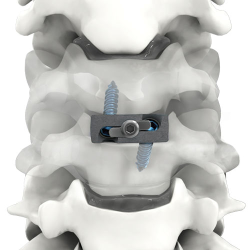 Gabbia intersomatica cervicale - PRO-LINK® - Life Spine - via anteriore / in titanio