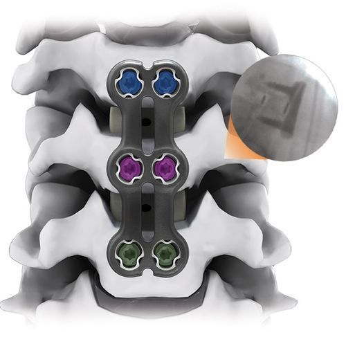 Placca per artrodesi per vertebra cervicale - IRIS® - Life Spine - bloccata / 2 livelli