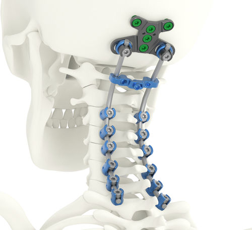 Sistema di osteosintesi occipito-cervico-toracico - SOLSTICE® - Life Spine - via posteriore / per adulti