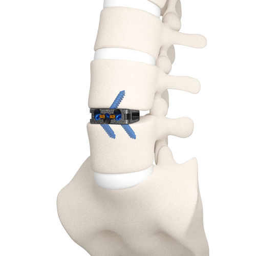 Gabbia intersomatica lombare - DYNA-LINK® - Life Spine - via anteriore / in titanio