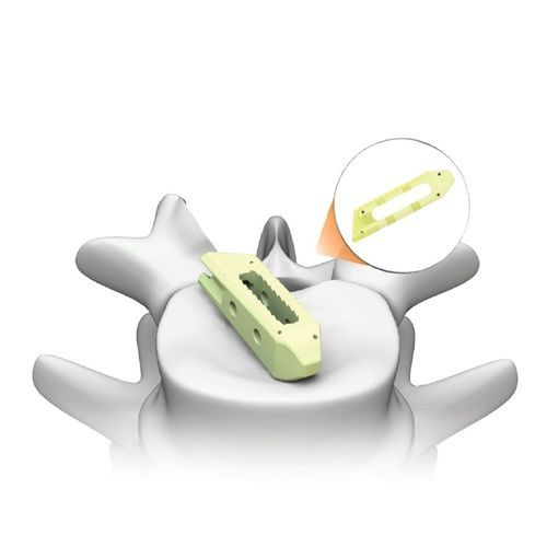 Gabbia intersomatica lombare - PLATEAU®-LO - Life Spine - via transforaminale / via obliqua