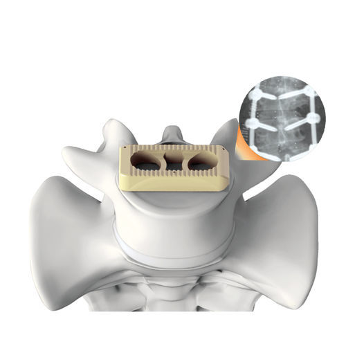 Gabbia intersomatica lombare - PLATEAU®-X - Life Spine - via laterale / in PEEK