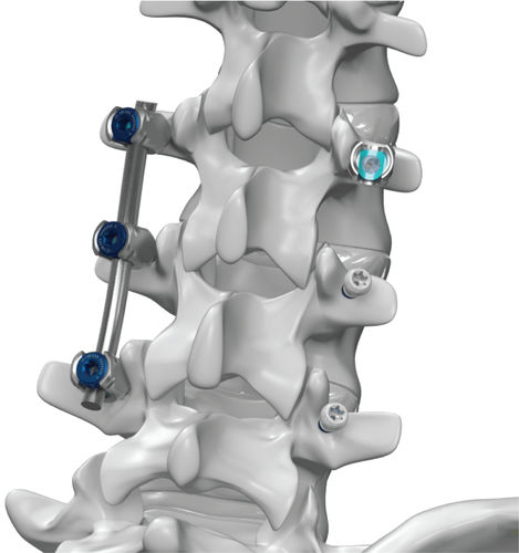 Sistema di osteosintesi toraco-lombare - ARx® - Life Spine - via posteriore / per adulti