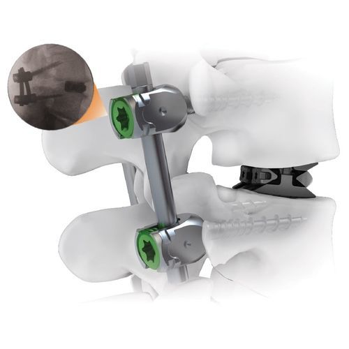 Sistema di osteosintesi toraco-lombare - CENTERLINE® - Life Spine - via posteriore / per adulti