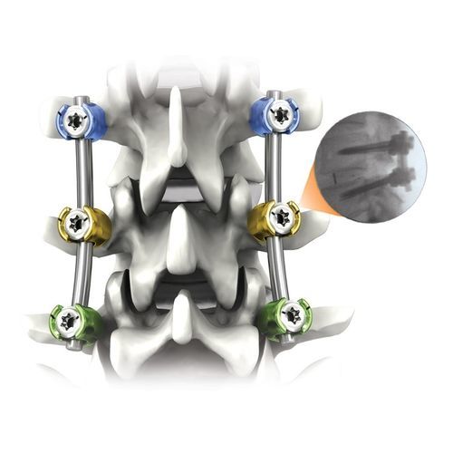 Sistema di osteosintesi toraco-lombare - NAUTILUS® - Life Spine - via posteriore / per adulti