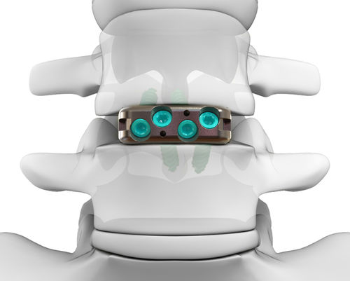 Gabbia intersomatica lombare - DYNA-LINK® ELITE - Life Spine - via anteriore