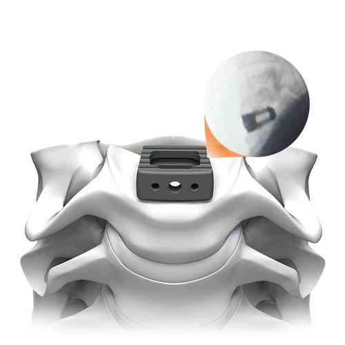 Gabbia intersomatica cervicale - PLATEAU®-C Ti - Life Spine - via anteriore / in titanio