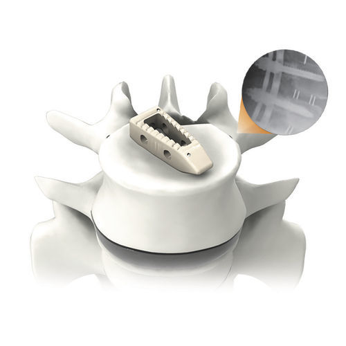 Gabbia intersomatica toraco-lombare - PLATEAU®-P - Life Spine - via posteriore / in PEEK