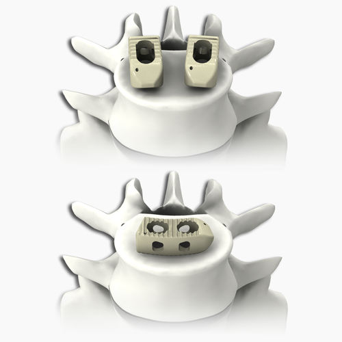 Gabbia intersomatica lombare - PLATEAU® - Life Spine - via posteriore / via transforaminale / in PEEK
