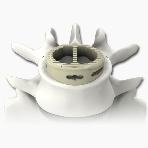 Gabbia intersomatica lombare - PLATEAU®-A - Life Spine - via anteriore / in PEEK