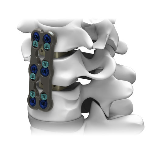 Placca per artrodesi cervicale - GRUVE™ - Life Spine - bloccata / in metallo / 2 livelli