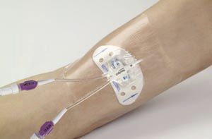 Catetere venoso centrale - Xcela® PICC - Navilyst Medical
