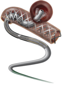 Microcatetere per accesso - Headway® - MicroVention - di vaso sanguigno / umano