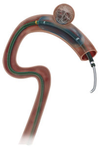 Catetere per occlusione - Scepter C® - MicroVention - di vaso sanguigno / con palloncino / con rivestimento idrofilico