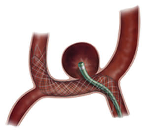 Stent periferico - LVIS™ Jr. - MicroVention - in nitinol / autoespandibile
