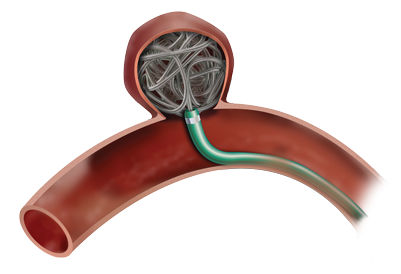 Spirale per embolizzazione - HyperSoft® 3D - MicroVention