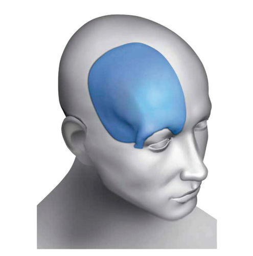 Impianto cranico su misura - Matrix Omnipore®  - Acumed