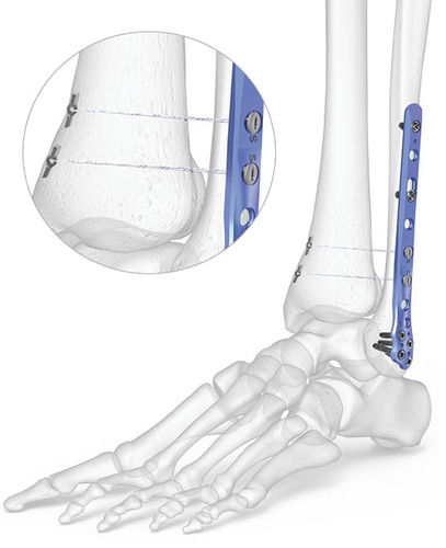 Placca di compressione per tibia - 7007-0 series - Acumed - per fibula / per caviglia / distale
