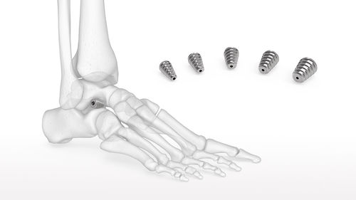 Impianto dell'articolazione subtalare - Talar-Fit™ - Acumed