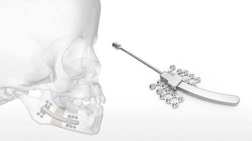 Distrattore mandibolare - Logic™ Jr - Acumed - interno / pediatrico