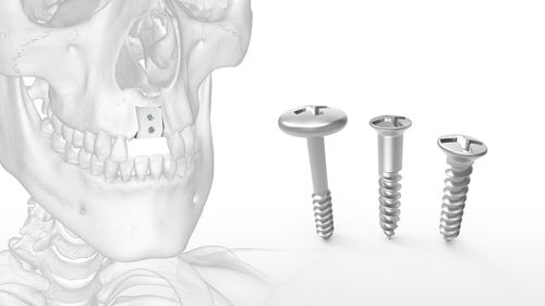 Strumentario chirurgico per implantologia ossea -  Mincro™ - Acumed