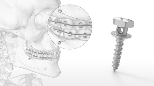 Miniimpianto in titanio - OMI™ - Acumed - a vite / di ancoraggio ortodontico / corticale