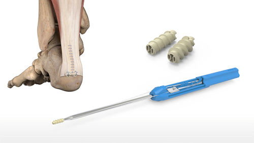 Ancora per sutura tendine calcaneale - 46-0008-S - Acumed - legamento talo-calcaneare / non assorbibile