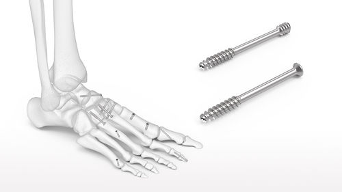 Vite per compressione ossea per retropiede - ExtremiFix™ - Acumed - per caviglia / canalare / senza testa