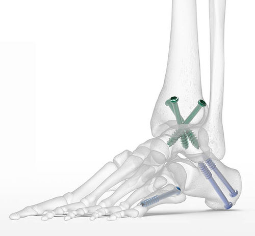 Vite per compressione ossea per piede - Acumed - canalare / in metallo