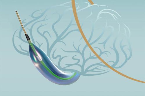 Catetere per dilatazione - Neuro LPS™ - SINOMED - neurologico / con palloncino