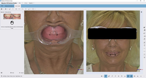 Modulo software odontoiatrico - 3D Denture Guide - AGE Solutions - di acquisizione