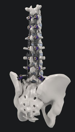 Sistema di osteosintesi toraco-lombare - SYNSTER® DOMINO - BM Korea - via posteriore / per adulti