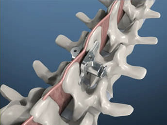 Impianto vertebrale interspinale lombare - PITBULL® - BM Korea - sacrale / toracico