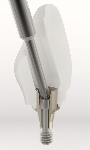 Pilastro dentale per impianto in titanio - BH - DESS AURUM Base™ - Dess Dental Smart Solutions - ad esagono esterno / dritto
